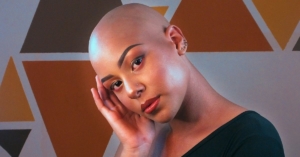 A person with Alopecia Totalis looking at the camera